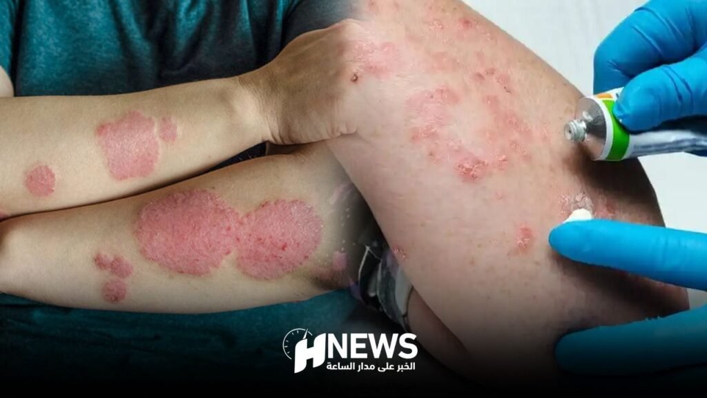 مؤتمر وطني حول خطورة مرض الصدفية