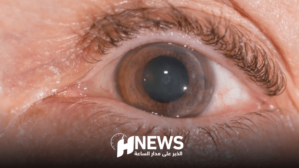 زراعة القرنية | H-NEWS آش نيوز