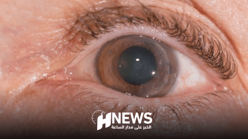 جراح عيون: عملية زرع القرنية تساعد أزيد من 500 مغربي على استرجاع البصر