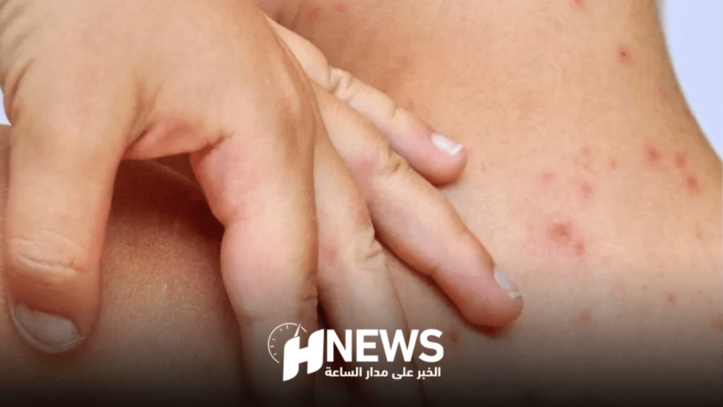 “بوحمرون” في ارتفاع.. ووزارة الصحة تؤكد ضرورة اللقاح