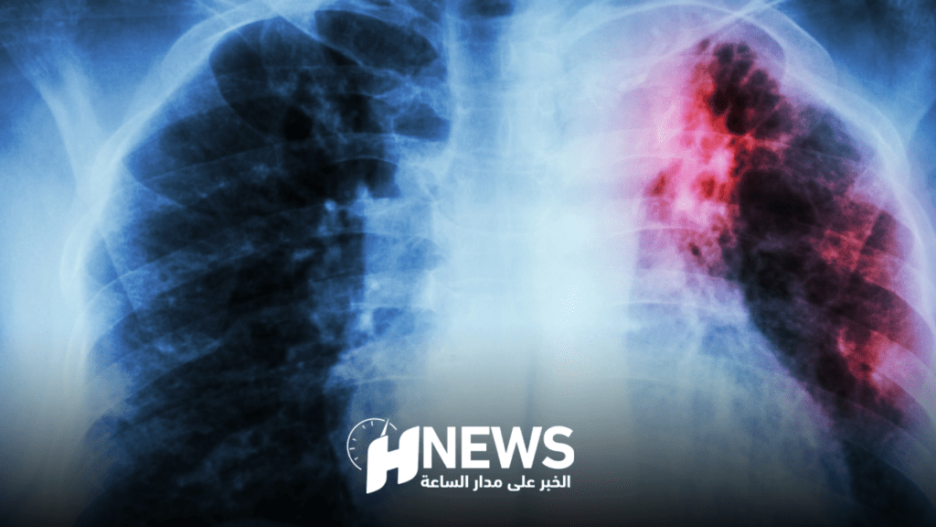 الطيب حمضي: حوالي 100 شخص يصاب بالسل يوميا في المغرب