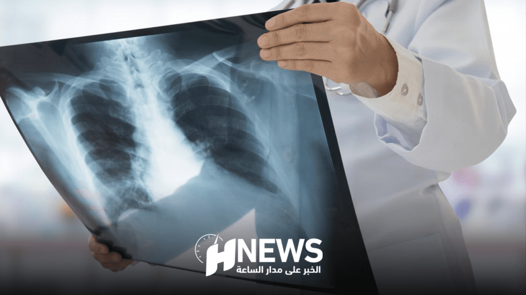 حبيب كروم: المغرب يسجل أرقاما مقلقة للإصابات بالسل