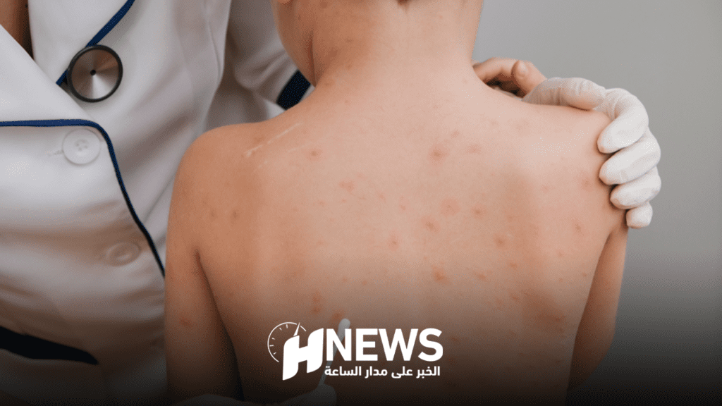 جدري القردة | H-NEWS آش نيوز جدري القردة