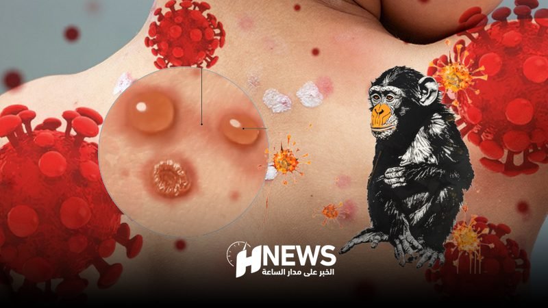 جدري الماء والقردة | H-NEWS آش نيوز جدري الماء والقردة