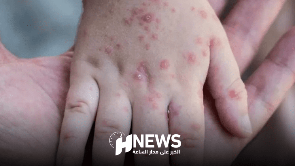 خبير: جدري القردة لن يؤدي إلى إقفال الحدود أو الحجر الصحي