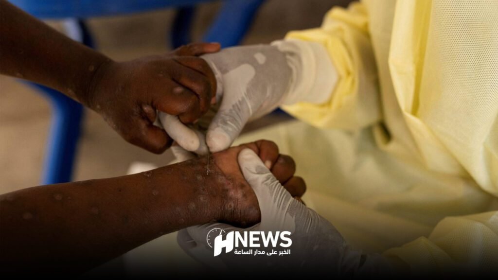 هل يهدد فيروس إمبوكس العالم من جديد؟ تطورات خطيرة بين أفريقيا وأوروبا