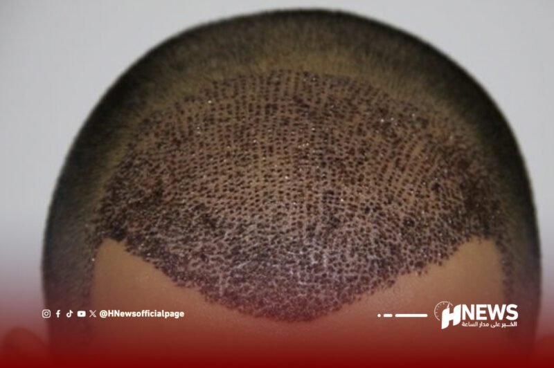 زراعة الشعر تركيا