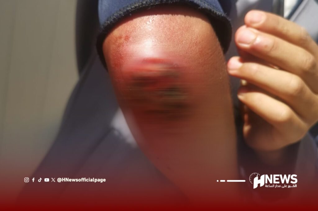 مرض جلدي معدي ينتشر بين أطفال منطقة الحوز