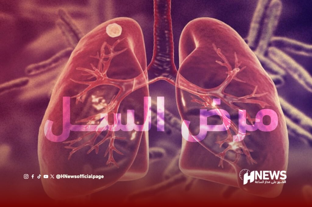 أرقام مقلقة.. السل يخرج عن شكله التقليدي بالمغرب