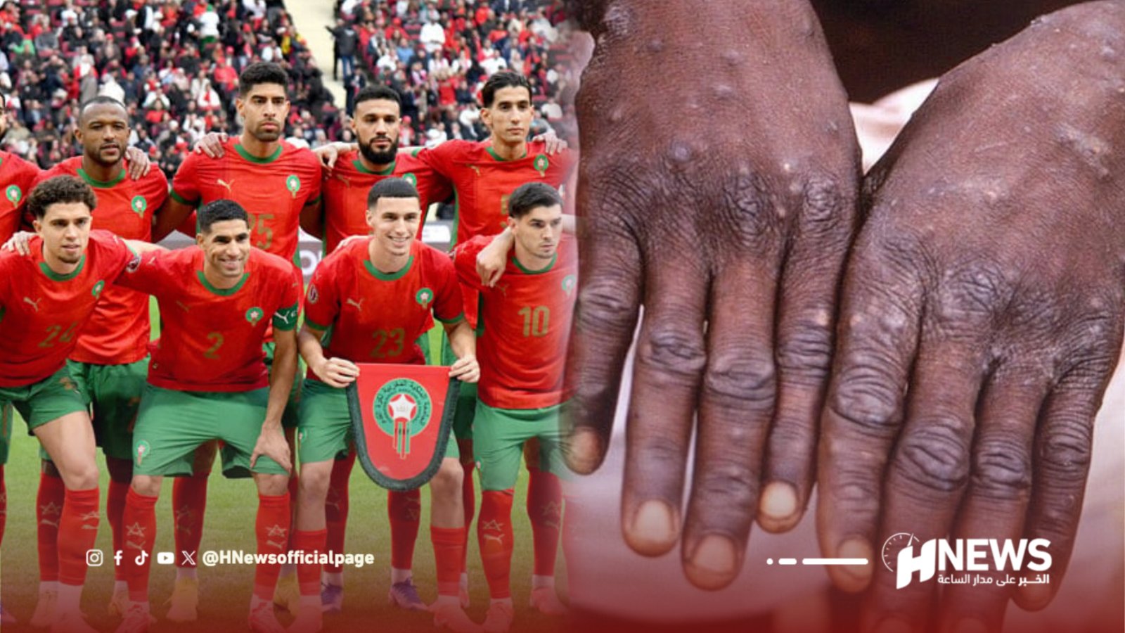بجدري القردة